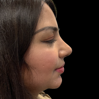 ethnic-rhinoplasty-after